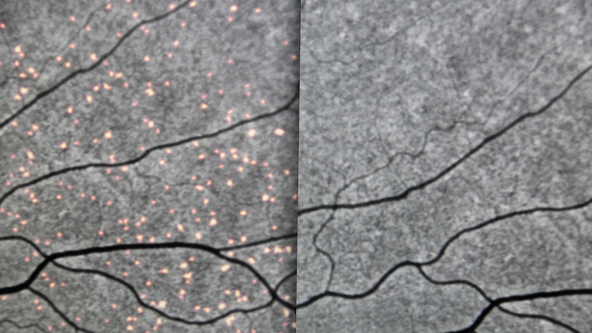 Retina scans showing beta-amyloids