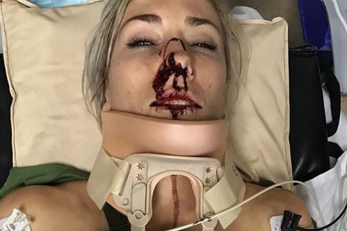 Caroline Buchanan in a hospital bed with a bloodied nose and a neck brace.