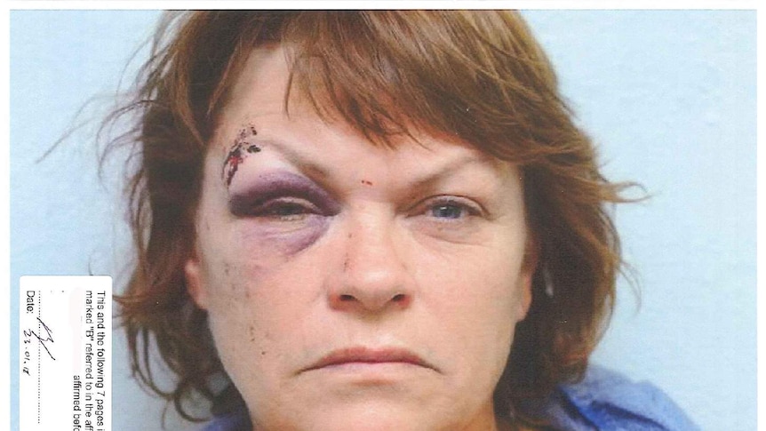 Police photo of Jonda Stephen's face showing one bruised and swollen eye with a cut on the eyebrow