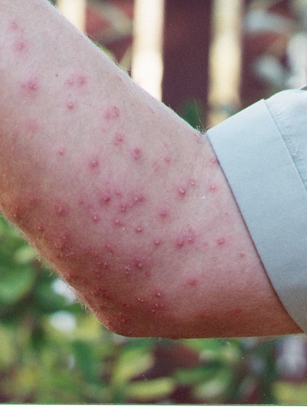 An image of what fire ant bites look like on a person's forearm 18 hours after initial bite