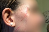 A blurred image of scratches a victim sustained during an alleged attack.