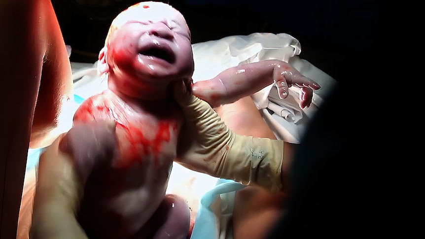 A newborn baby straight after delivery.