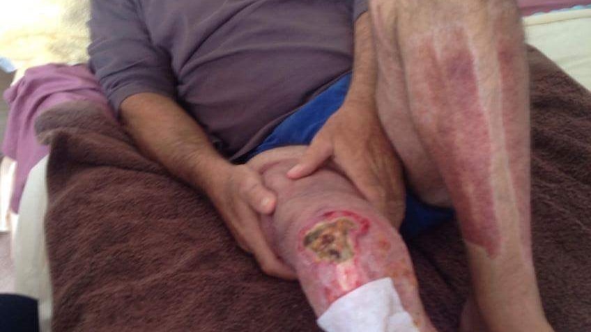 Man lies on bed with his leg out showing an exposed kneecap as a result of a flesh-eating disease.