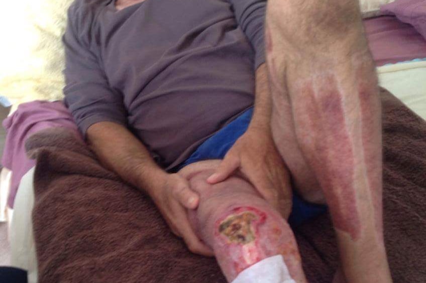 Man lies on bed with his leg out showing an exposed kneecap as a result of a flesh-eating disease.