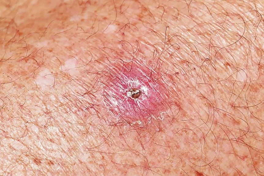 A picture of the start of a flesh-eating ulcer on the skin.