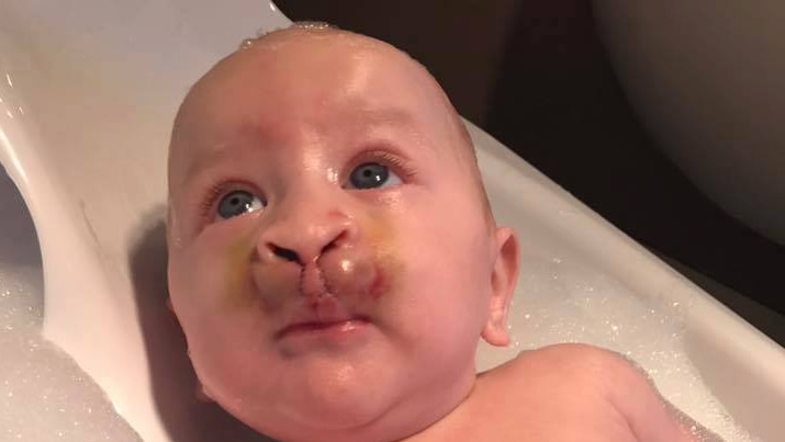 Charlie Halliday, who was born with a cleft palate