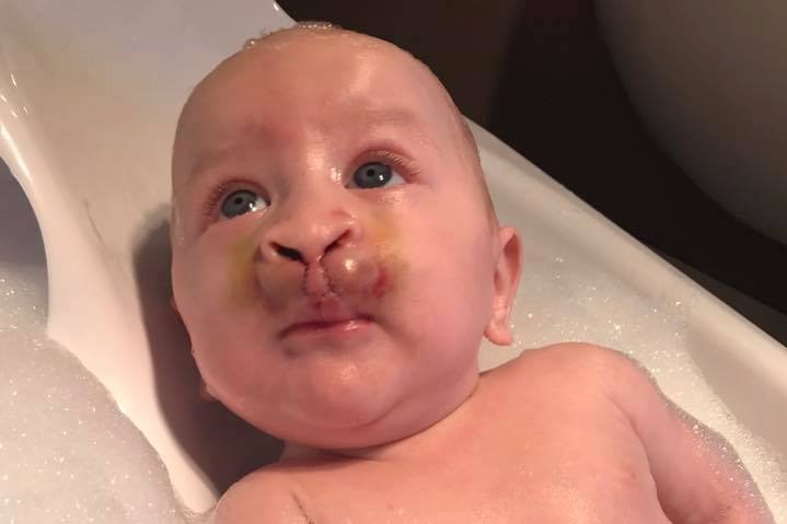 Charlie Halliday, who was born with a cleft palate