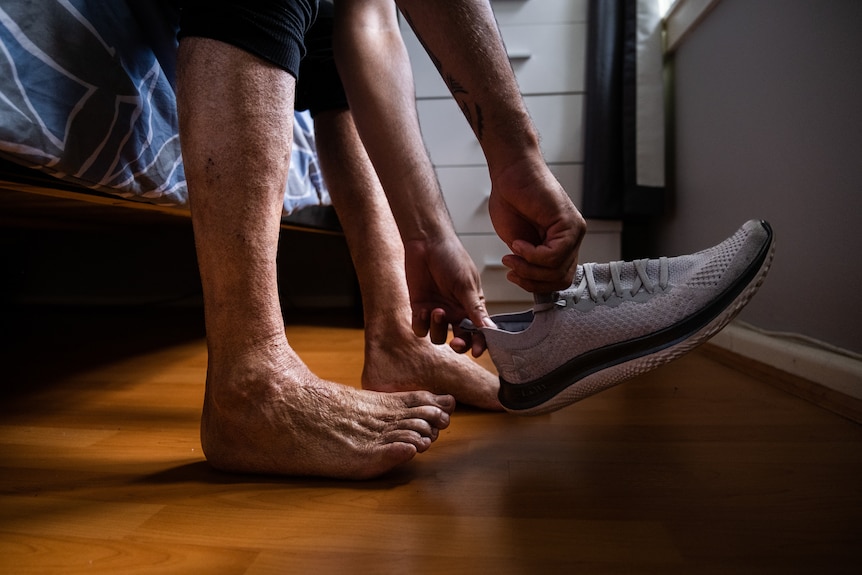 A mans prepares to put a running shoe on a foot which has the scars of burns and skin grafts up its shin.
