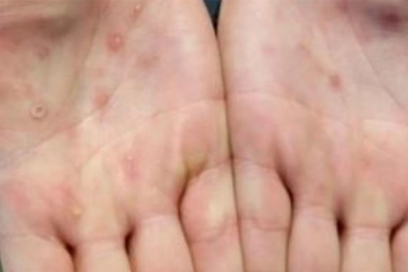 Monkeypox lesions small bumps cover the palms of hands.