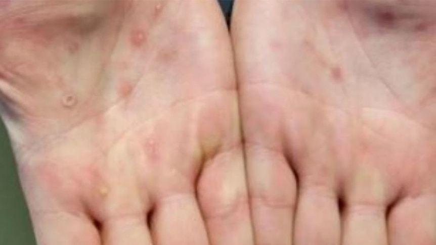 Monkeypox lesions small bumps cover the palms of hands.