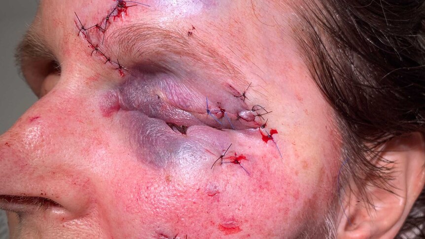 A woman with a black eye and stitches