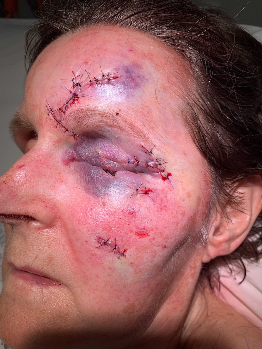 A woman with a black eye and stitches