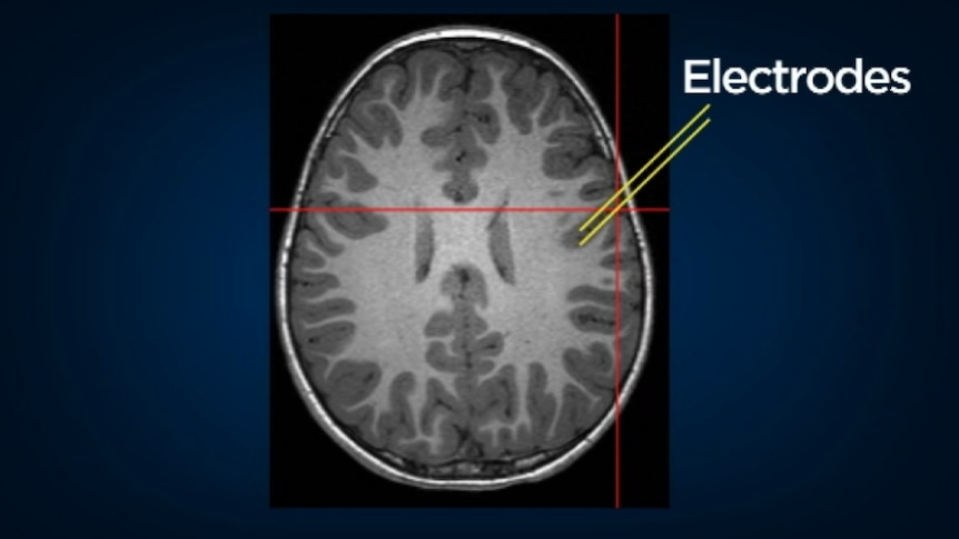 An MRI of Rowena Alexander's brain
