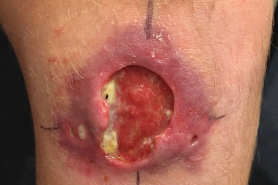 The knee of an 11-year-old boy shows a severe lesion caused by a Buruli ulcer.