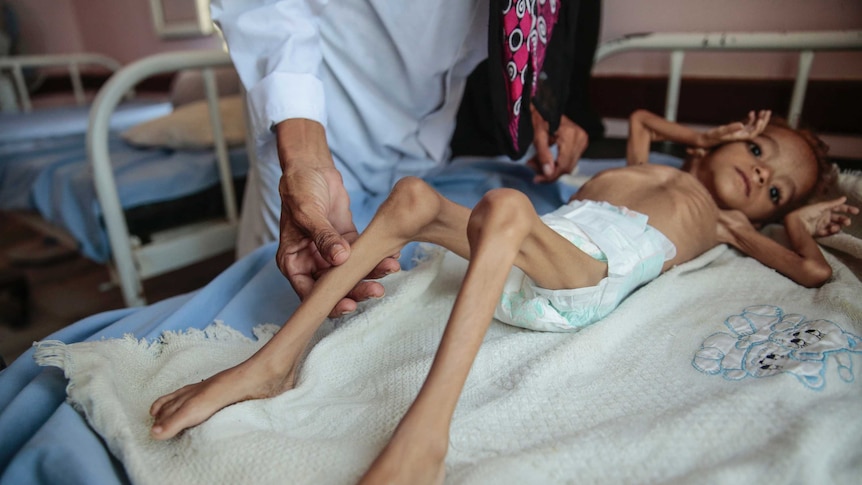 A severely malnourished boy rests on a hospital bed in Yemen