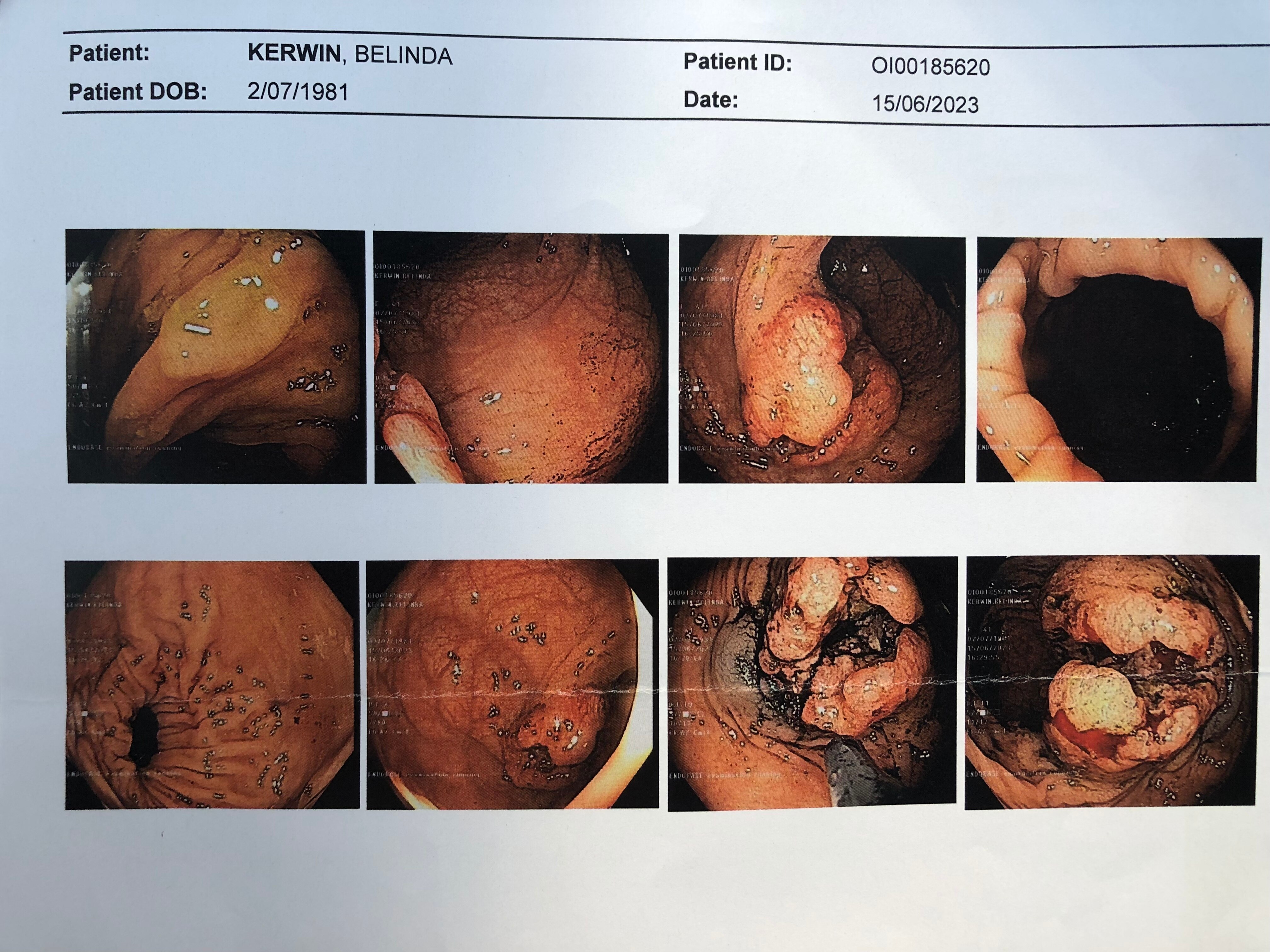 A picture shows a colon cancer diagnosis.