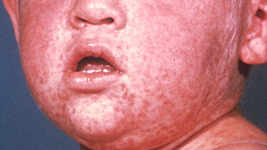 Third day measles rash.