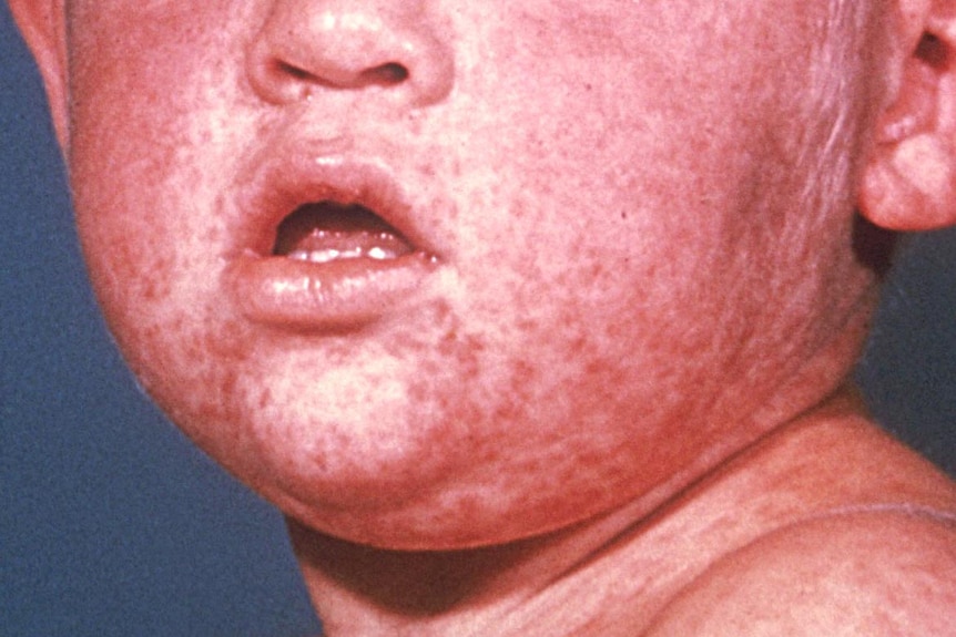 A boy with a third day measles rash.