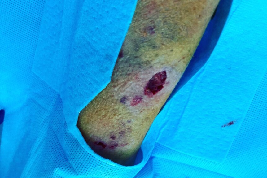 An arm with a wound surrounded by blue fabric