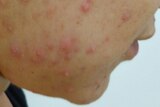 The side of a person's face with acne vulgaris.