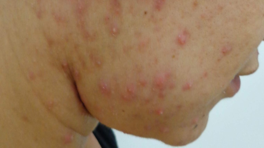 The side of a person's face with acne vulgaris.