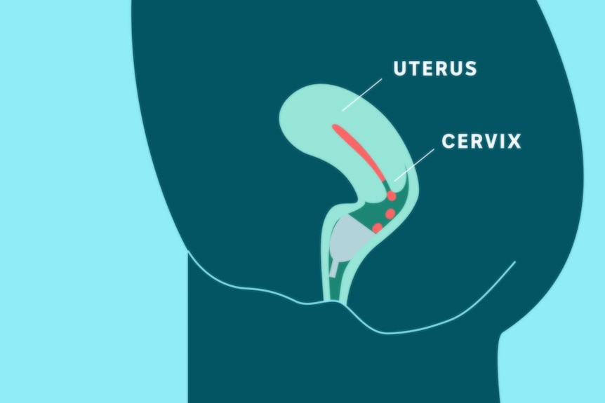 Illustration showing where a menstrual cup sits in the vaginal canal to catch blood under the cervix