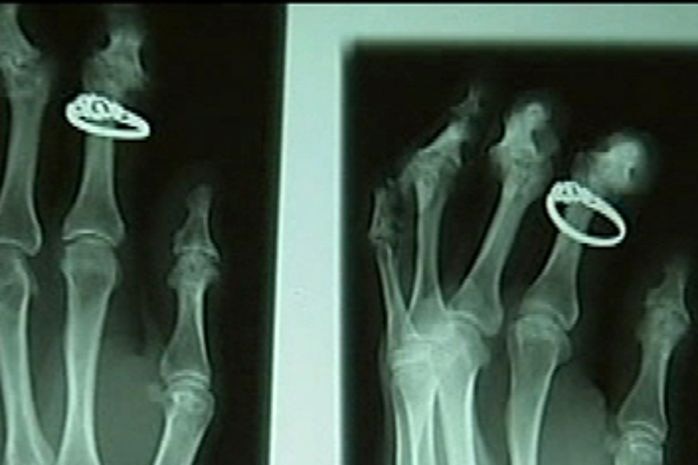 X-ray