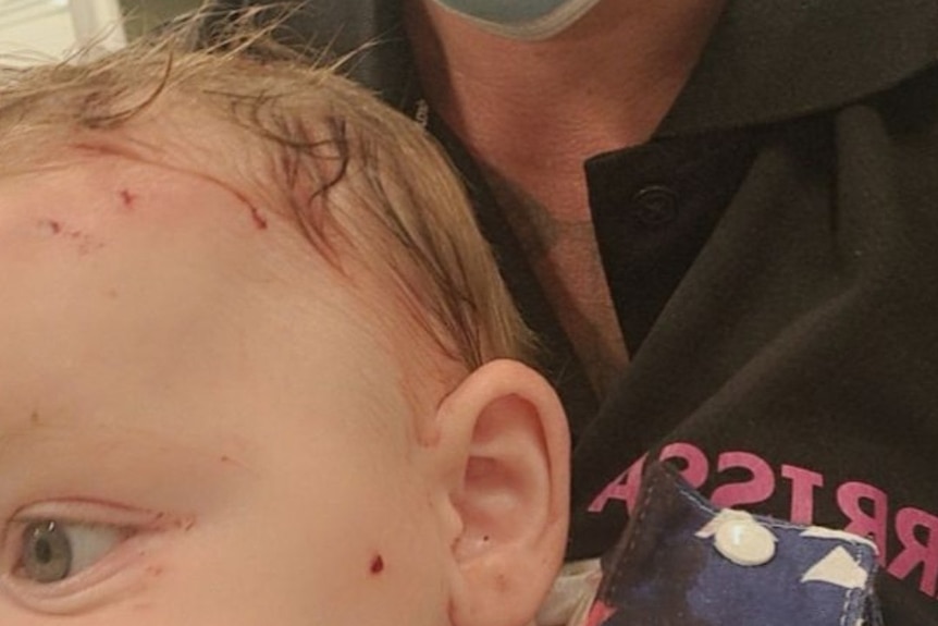 A mum wearing a mask holds her baby who has bite marks above his left eye
