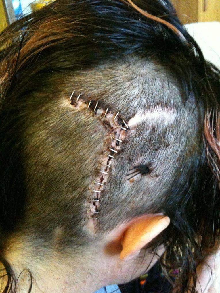 A shunt scar on a girl's shaved head