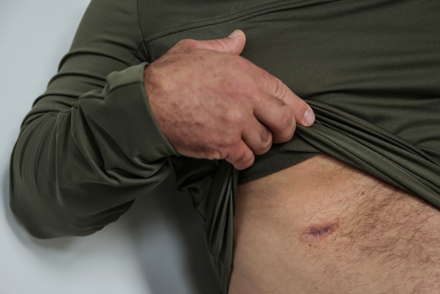 Close up of man pointing to scar on his side below his chest.