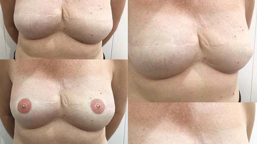 Before and after the cosmetic breast tattoo procedure