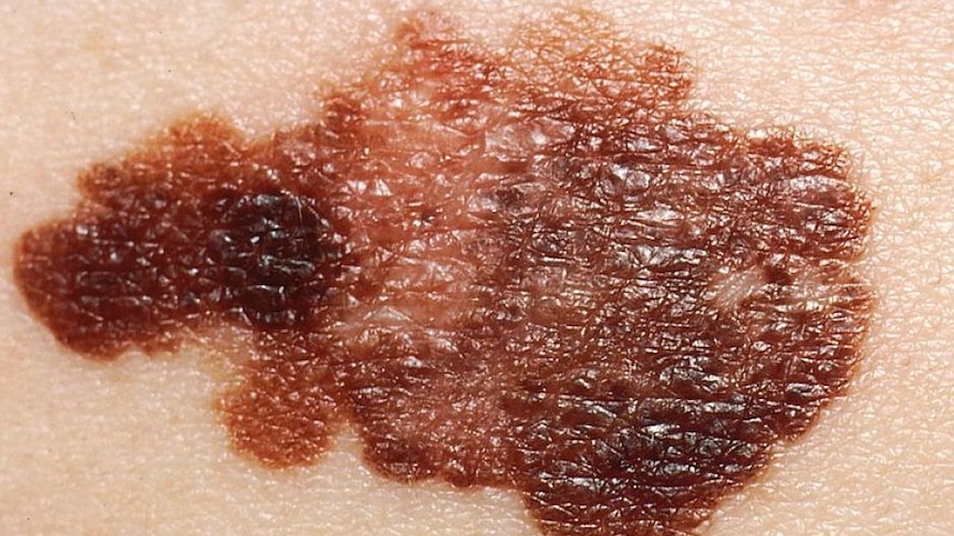 Melanoma