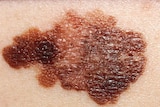 Melanoma