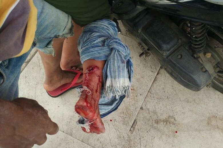 A local resident's ankle is gashed open from an attack.