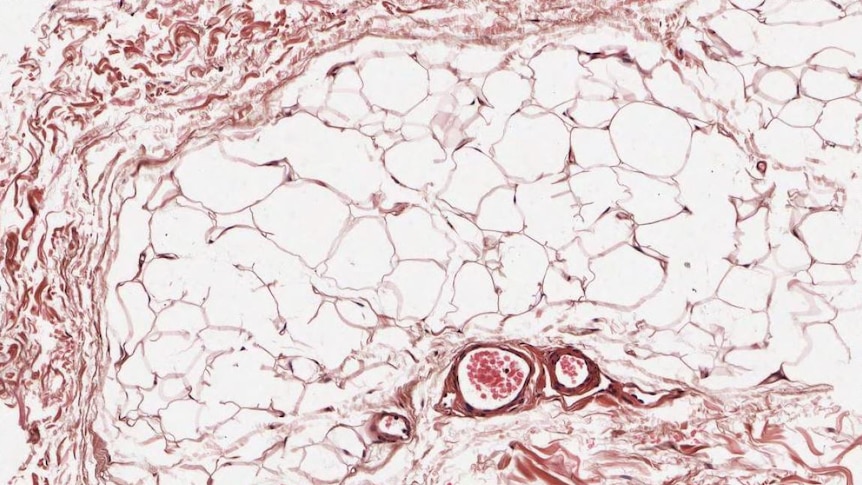 Subcutaneous fat cells swollen by accumulation of fats such as triglycerides and cholesterol esters at 100 times magnification
