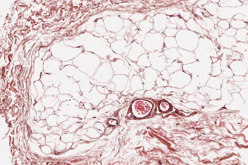 Subcutaneous fat cells swollen by accumulation of fats such as triglycerides and cholesterol esters at 100 times magnification