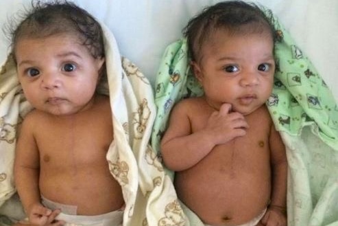 Two infant boys lying on a bed with blankets on them.  Both boys have vertical scars on their sternum from surgery.