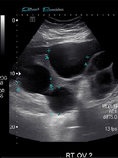 Ultrasound imagery showing multiple circles outlined in grey against a black backdrop