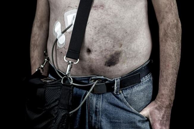 The torso of a man with scars and medical tubes attached to his skin, leading into a black bag at his hip.