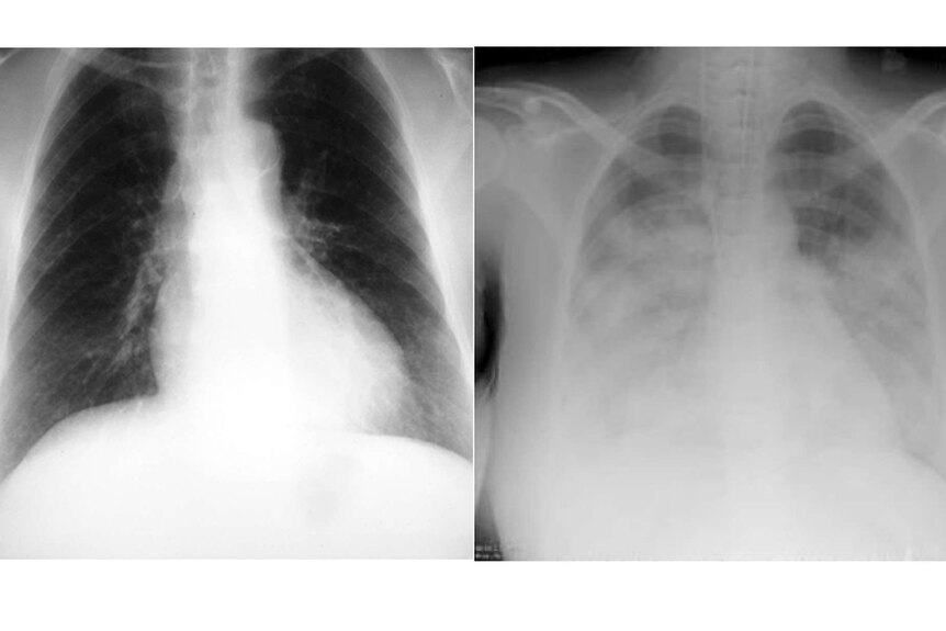 Two chest x-rays, one quite clear and the other very cloudy.