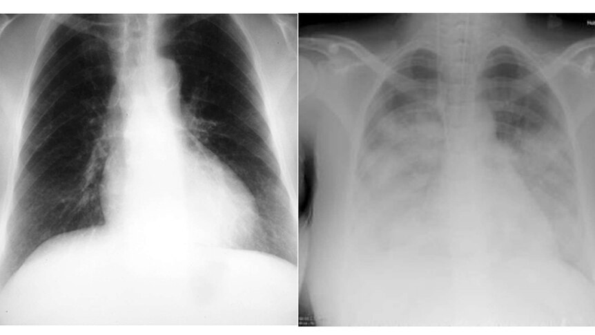 Two chest x-rays, one quite clear and the other very cloudy.