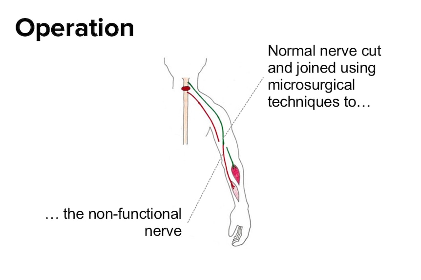 An illustration showing the procedure to cut  and join a healthy nerve and a non-functional nerve.