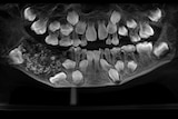 x-ray of the mouth