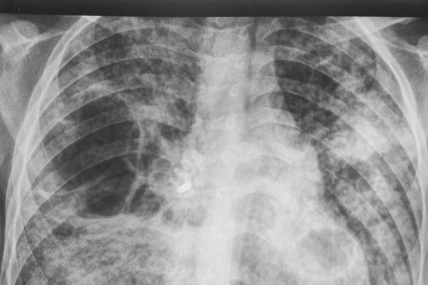 An x-ray of lungs with tuberculosis.