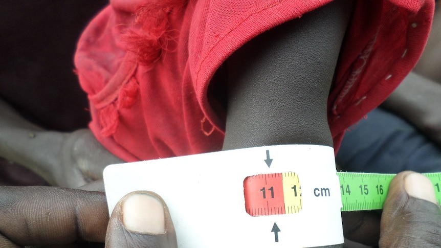 A child's arm being measured to detect child malnutrition