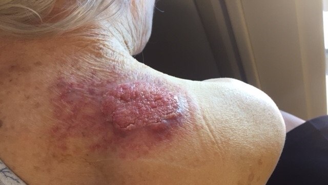Tracey says her mother's skin cancer is now hard to treat.