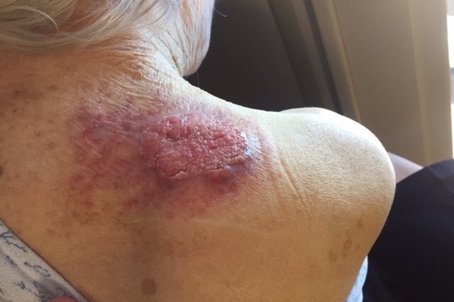 Tracey says her mother's skin cancer is now hard to treat.