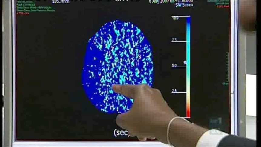 The three-year study was trialled on 75 stroke patients.