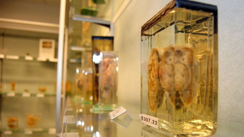 A disected lung sits in a glass jar at the Museum of Human Disease in Sydney.