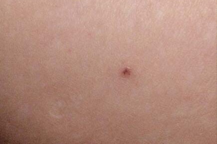 Melanoma spot on the calf of Brisbane woman Tanja Stark before it was removed on January 30, 2018.